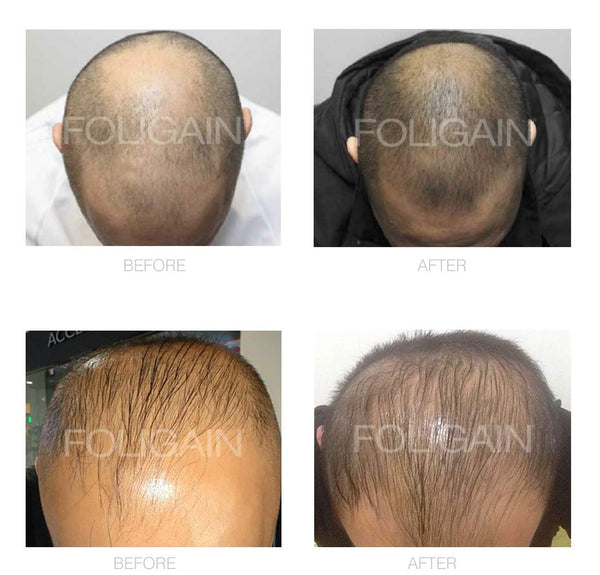 FOLIGAIN Men's Hair Regrowth Kit - FOLIGAIN Canada