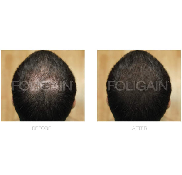 FOLIGAIN Minoxidil 5% Hair Regrowth Foam For Men 3 Month Supply - FOLIGAIN